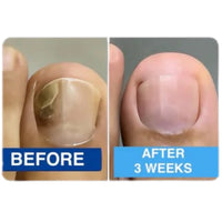 Nuvevia™ Fungal Nail Repair Patches