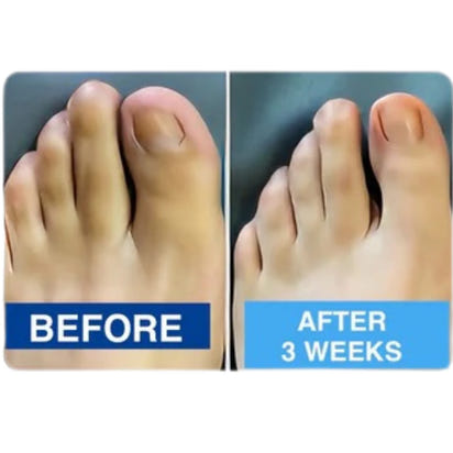 Nuvevia™ Fungal Nail Repair Patches