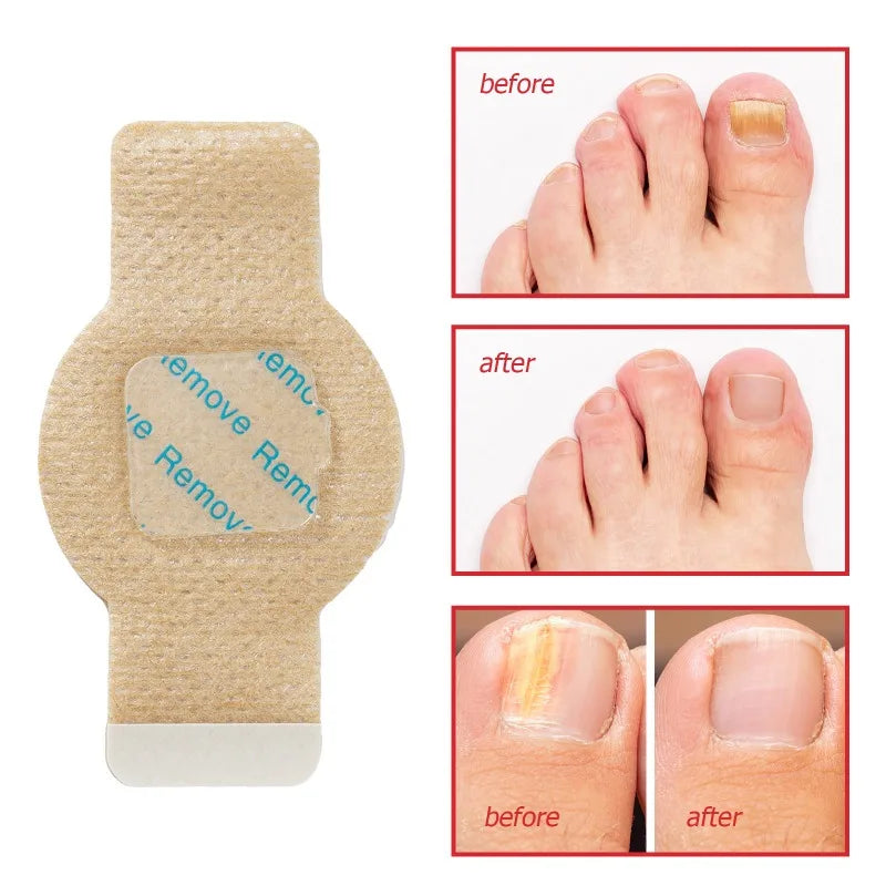 Nuvevia™ Fungal Nail Repair Patches