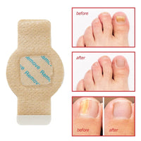 Nuvevia™ Fungal Nail Repair Patches